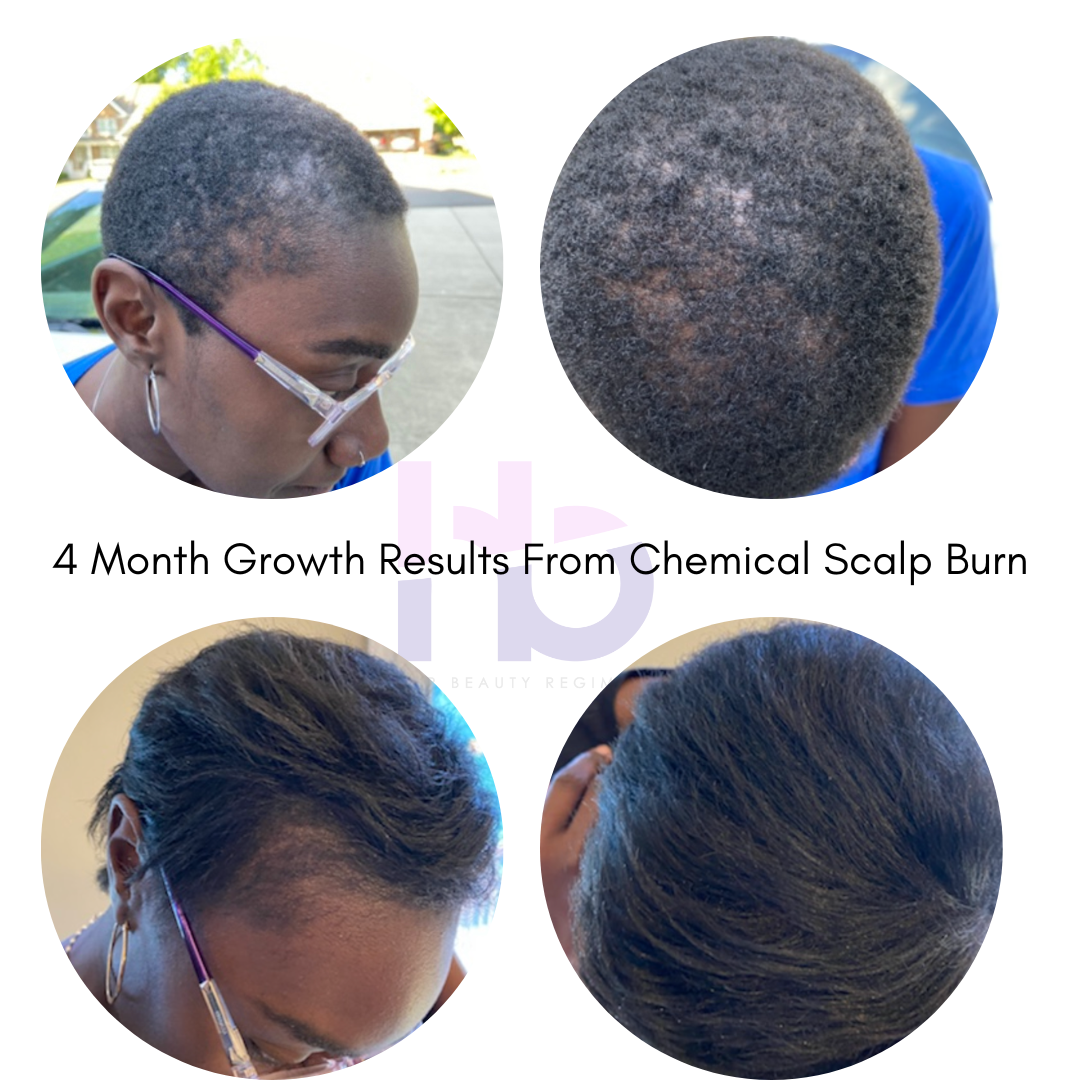 Real hair growth results using Refreshed Hair & Scalp Oil