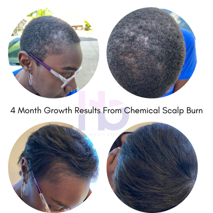 4-month hair growth results using Refreshed Hair & Scalp Oil